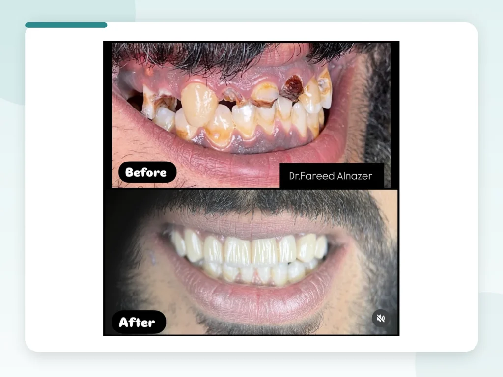 قبل وبعد | Before & After — Privea Dent