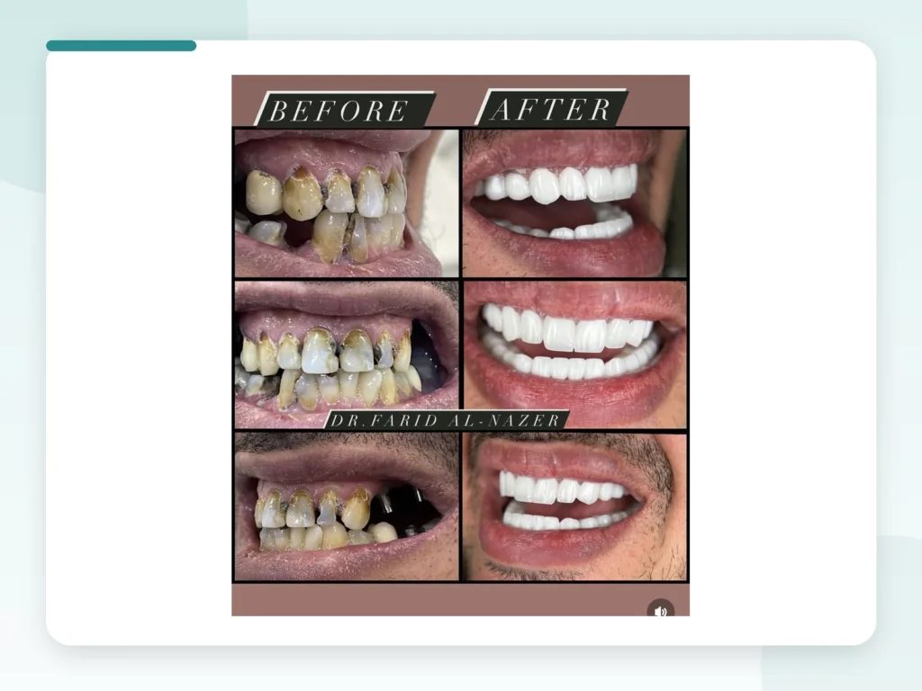 قبل وبعد | Before & After — Privea Dent