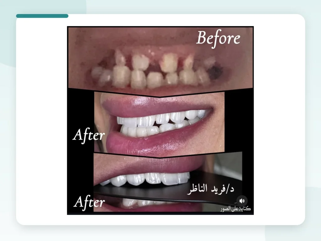 قبل وبعد | Before & After — Privea Dent