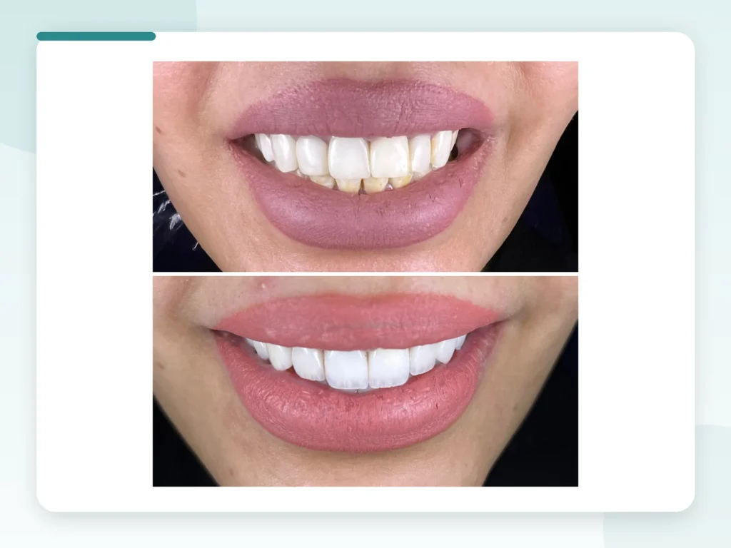 قبل وبعد | Before & After — Privea Dent