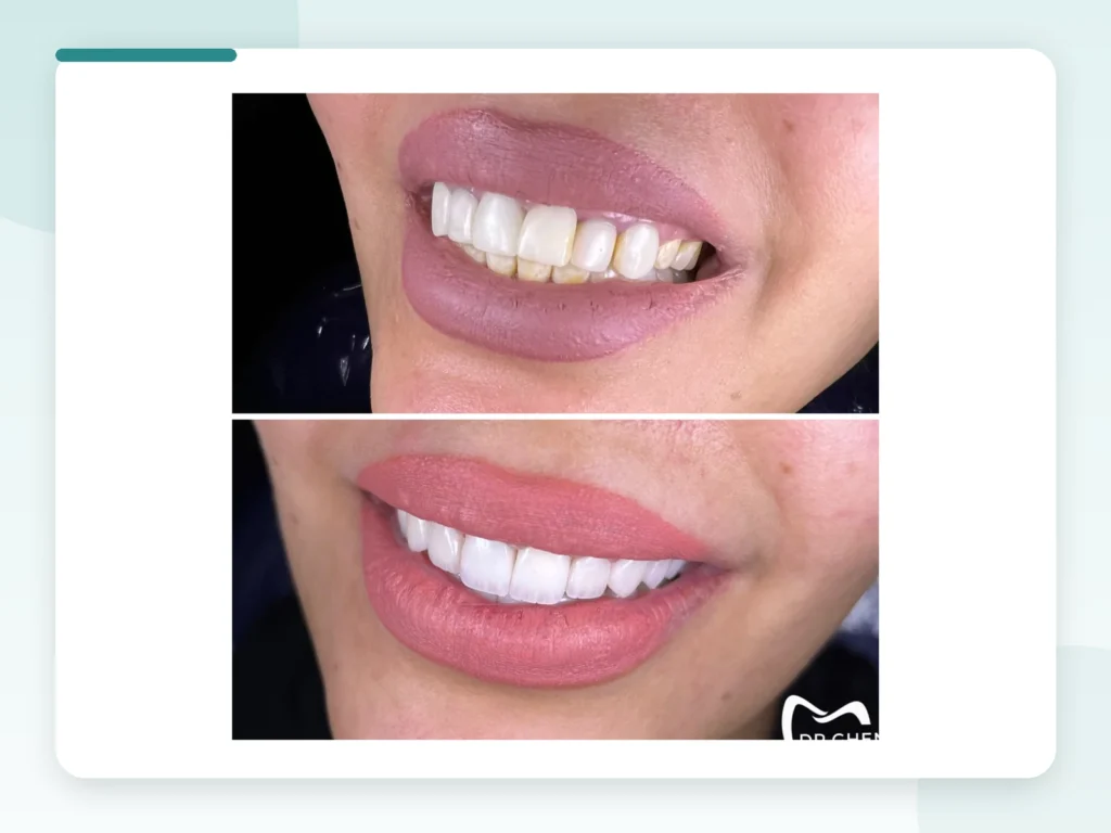 قبل وبعد | Before & After — Privea Dent