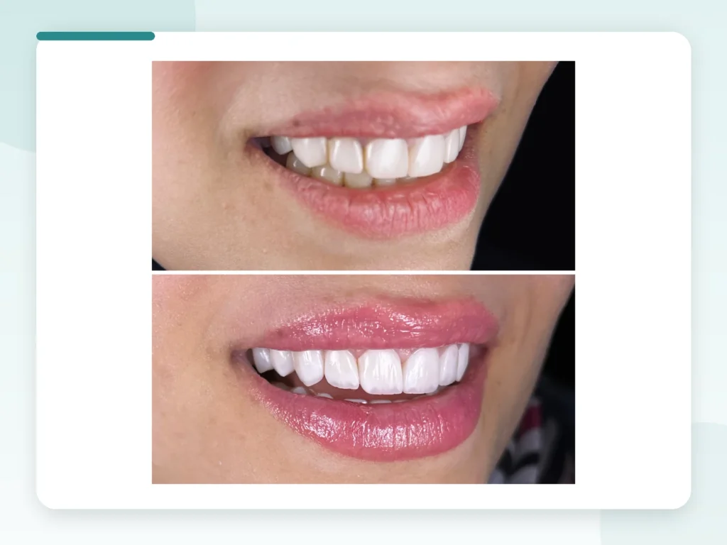 قبل وبعد | Before & After — Privea Dent