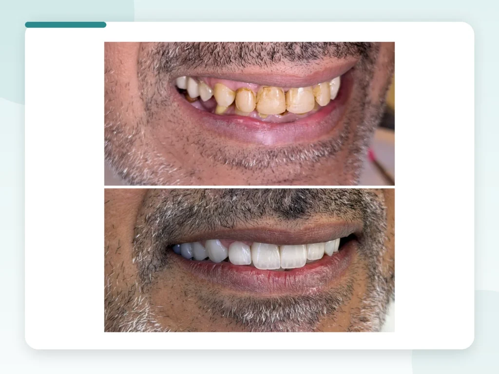 قبل وبعد | Before & After — Privea Dent