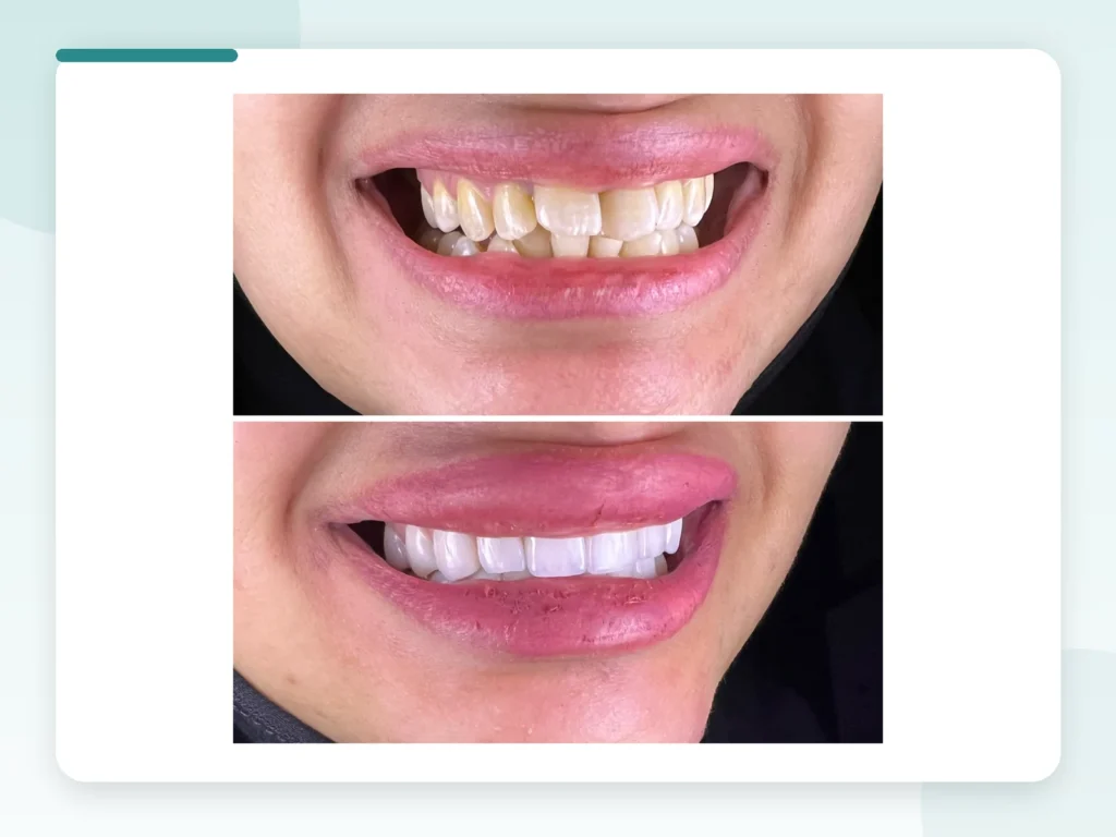 قبل وبعد | Before & After — Privea Dent
