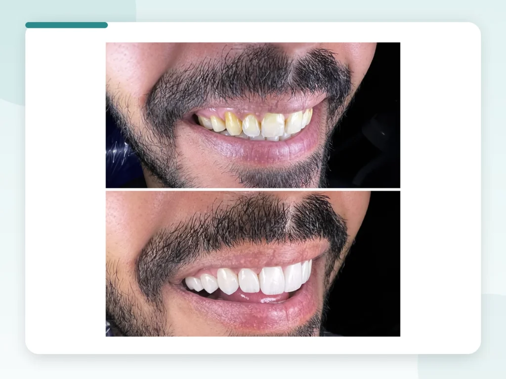 قبل وبعد | Before & After — Privea Dent